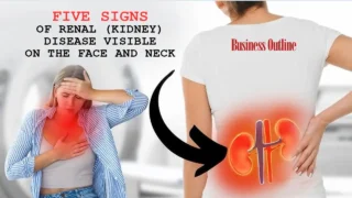 Five Signs of Renal Kidney Disease Visible on the Face and Neck copy
