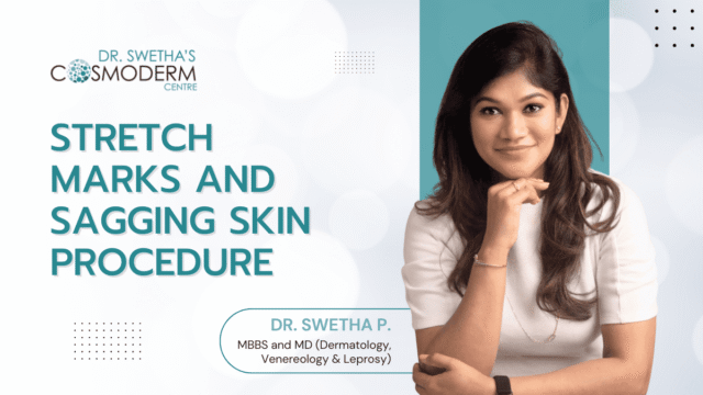 Stretch Marks and Sagging Skin Procedure: Transform Your Skin with Endolift: Dr. Swetha Panneerselvam 10 dr swethap